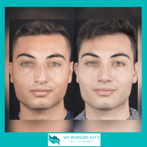 Tower Pisa Technique Rhinoplasty