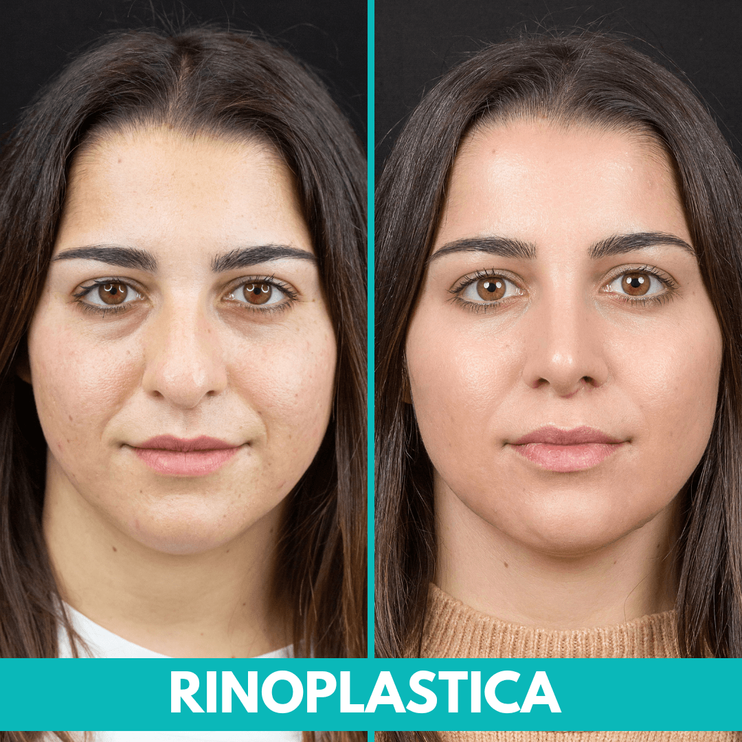 rinoplastica senza tamponi nasali