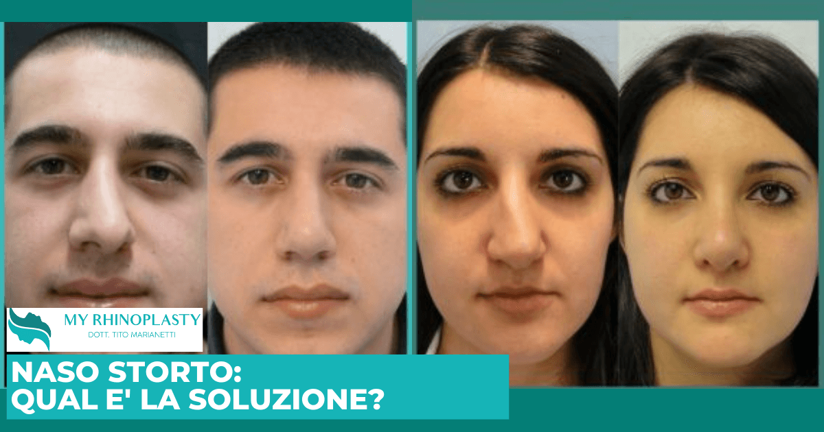 Naso storto