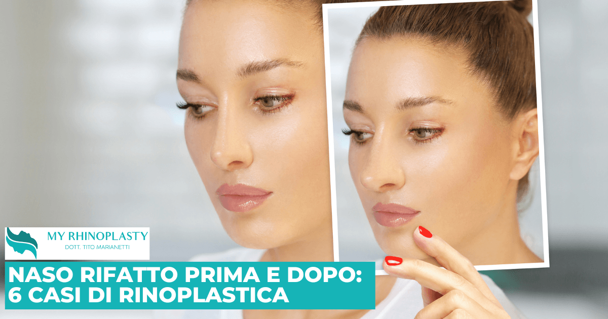 Naso rifatto prima e dopo
