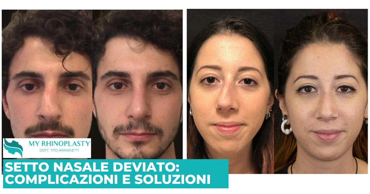 Setto nasale deviato