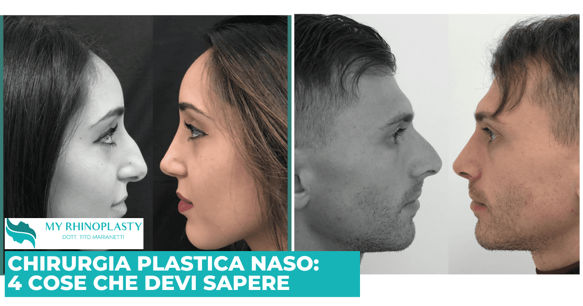 Chirurgia plastica naso