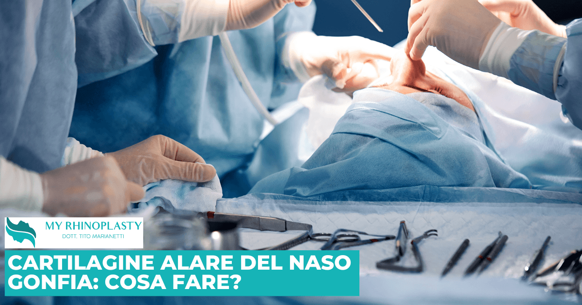 Cartilagine Alare naso gonfia