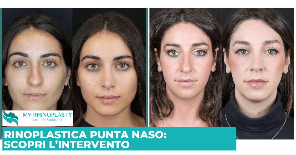 Rinoplastica Punta naso