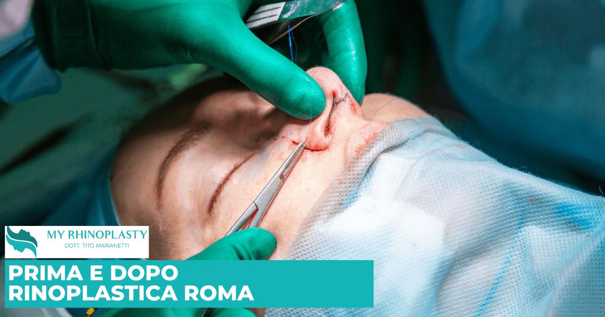 prima e dopo rinoplastica roma
