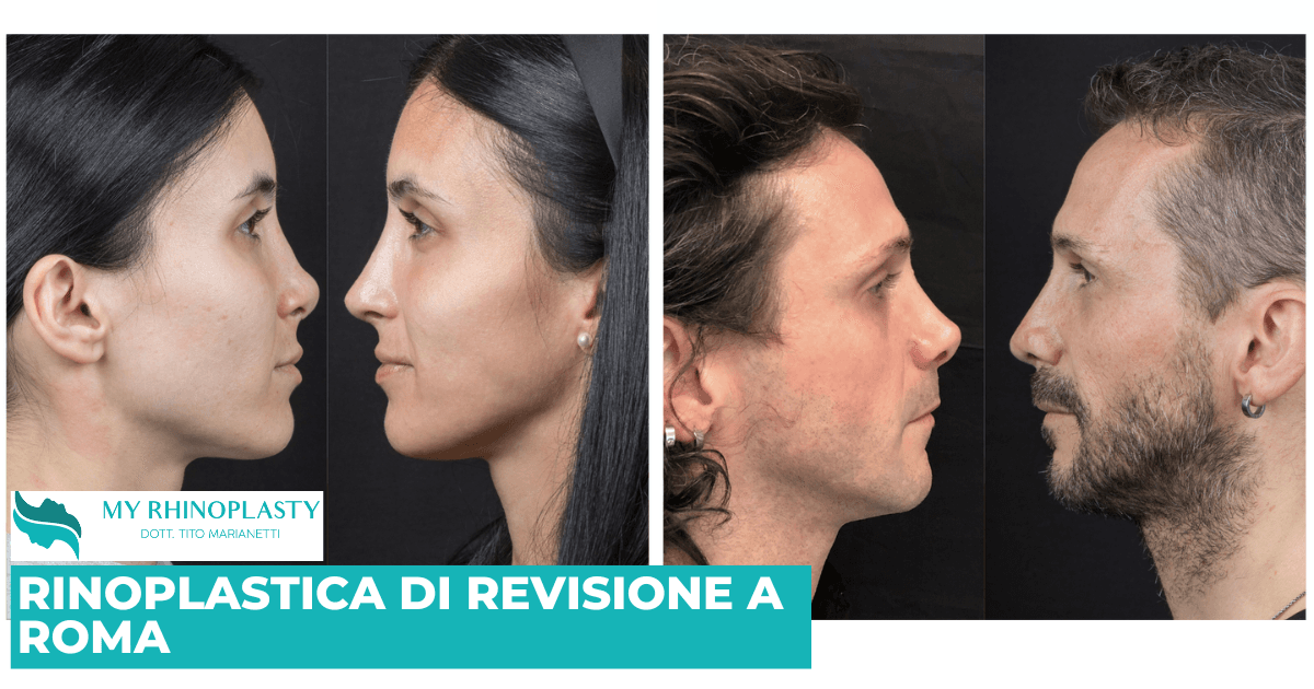 Rinoplastica di revisione Roma: cosa sapere