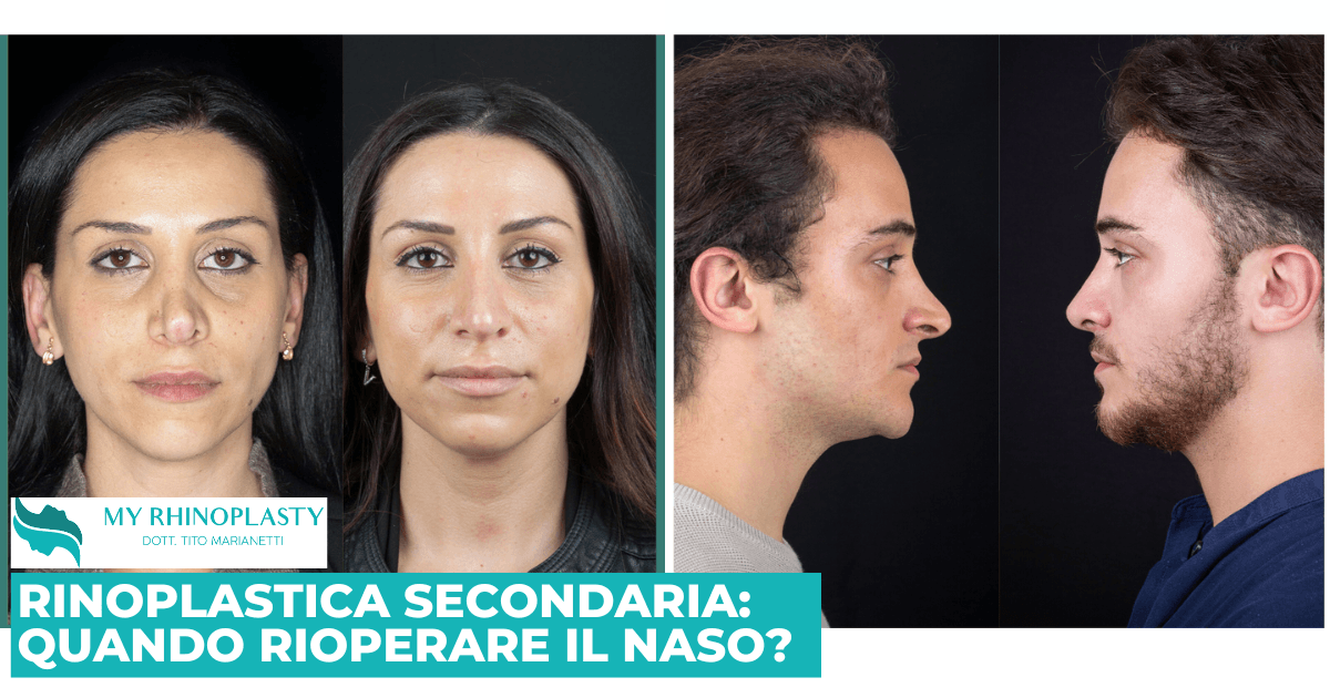 La rinoplastica secondaria: quando rioperarsi?