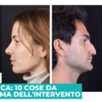 Rinoplastica: 10 cose da sapere prima dell’intervento