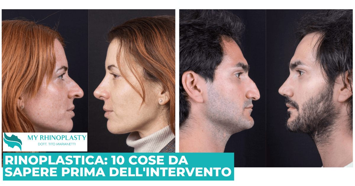 Rinoplastica: 10 cose da sapere prima dell'intervento