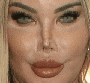 Barbie Nose Disastri