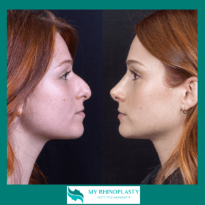 Barbie Nose - Italia