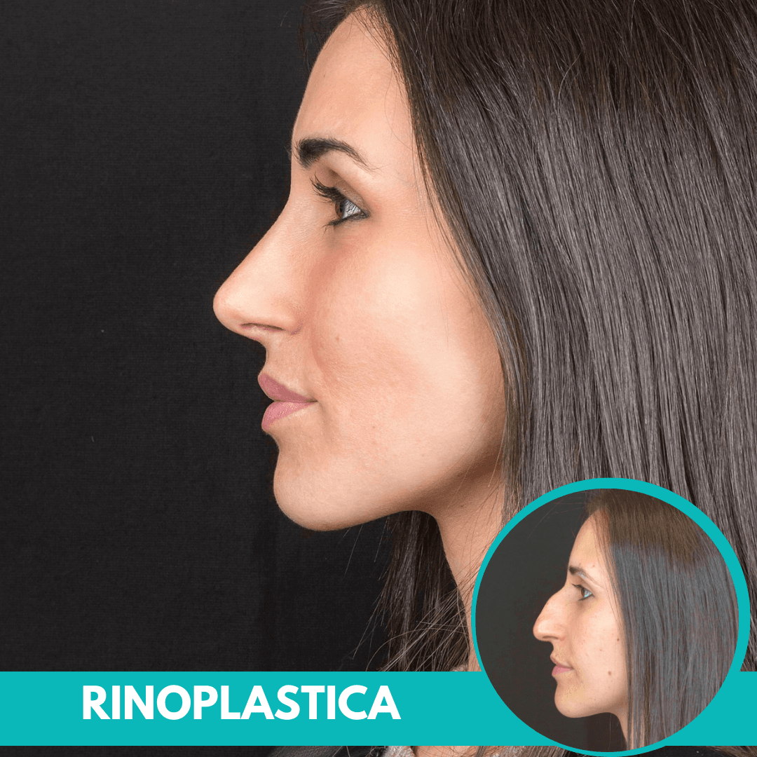 Rinoplastica prima e dopo