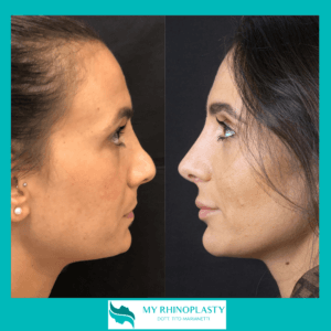 Supratip Nose 