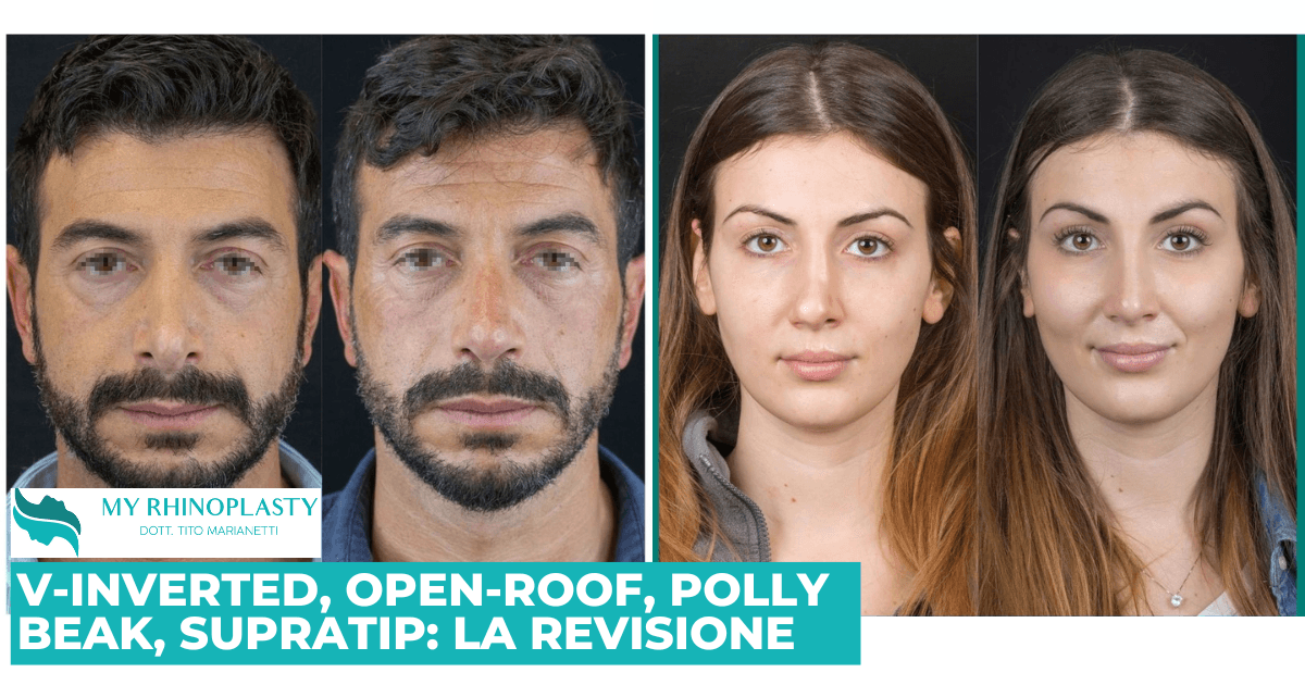 V-Inverted, Open Roof, Polly Beak, Supratip: la rinoplastica di revisione
