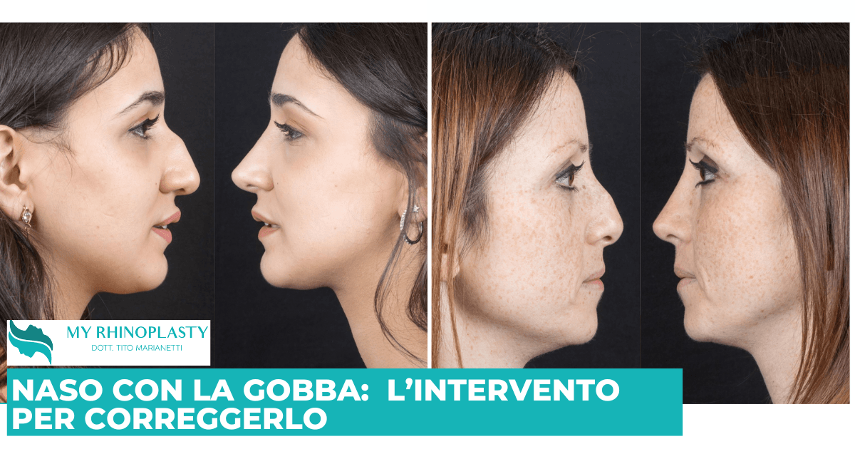 Naso con la gobba, rinoplastica, rinosettoplastica, gibbo nasale