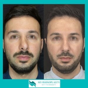 Intervento setto nasale deviato; operazione setto nasale deviato