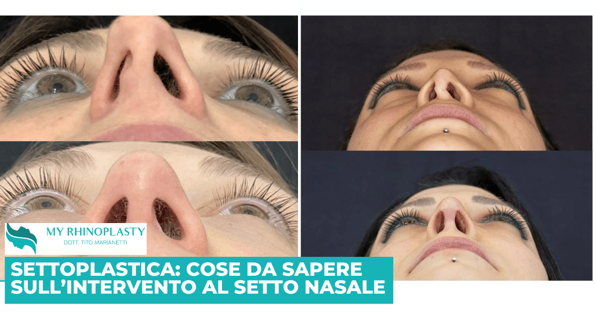 Settoplastica: cose da sapere sull’intervento di correzione del setto nasale