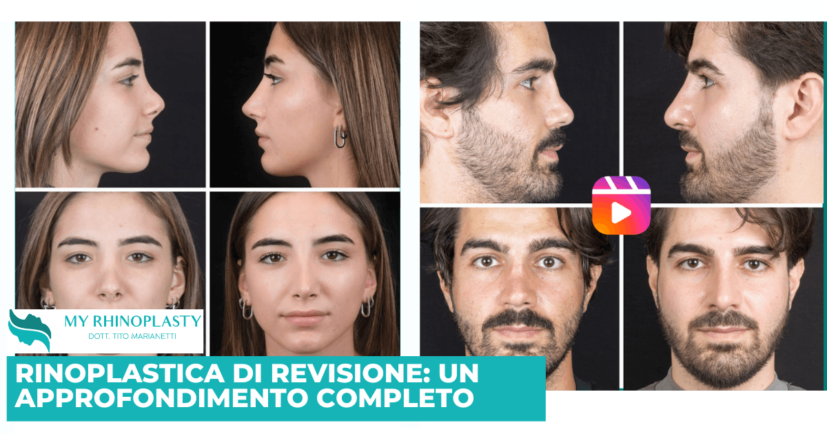 Rinoplastica di revisione: un approfondimento completo