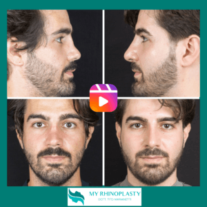 Rinoplastica di revisione