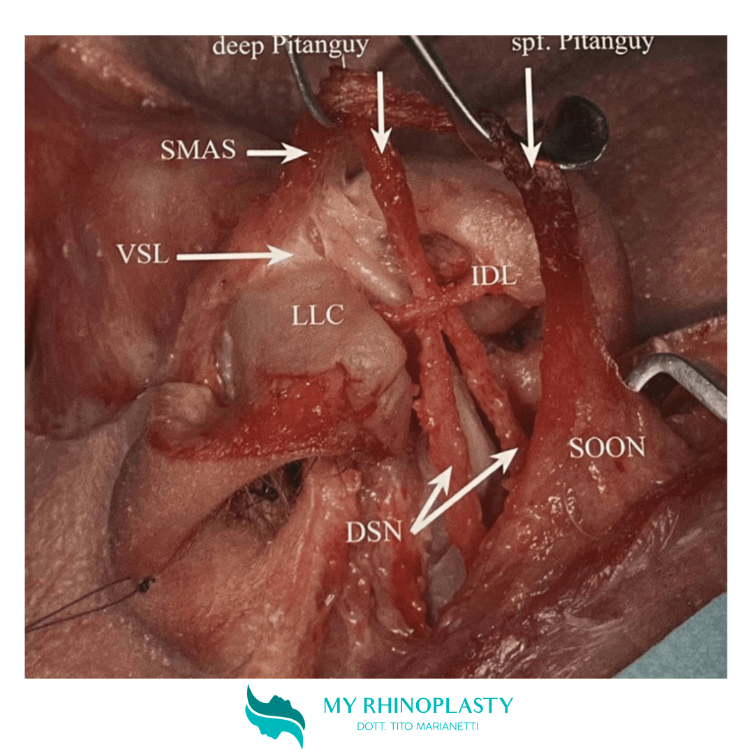 Interalar Ligament Flap